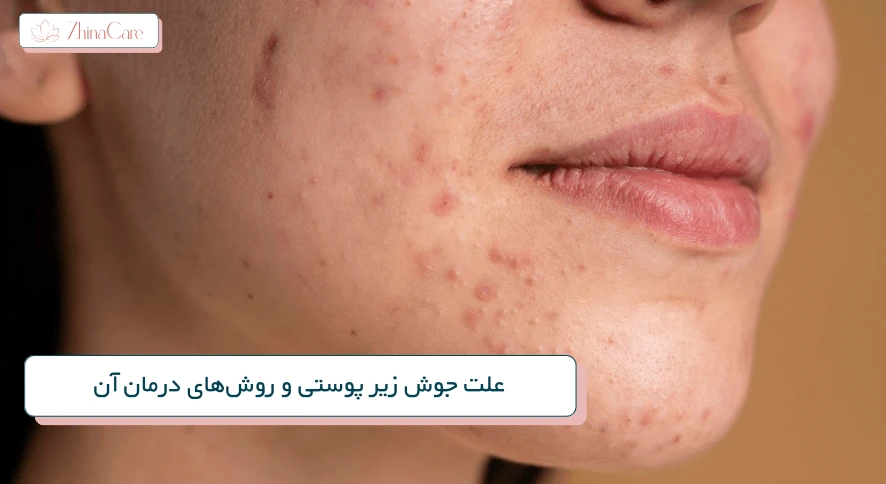 علت جوش زیر پوستی